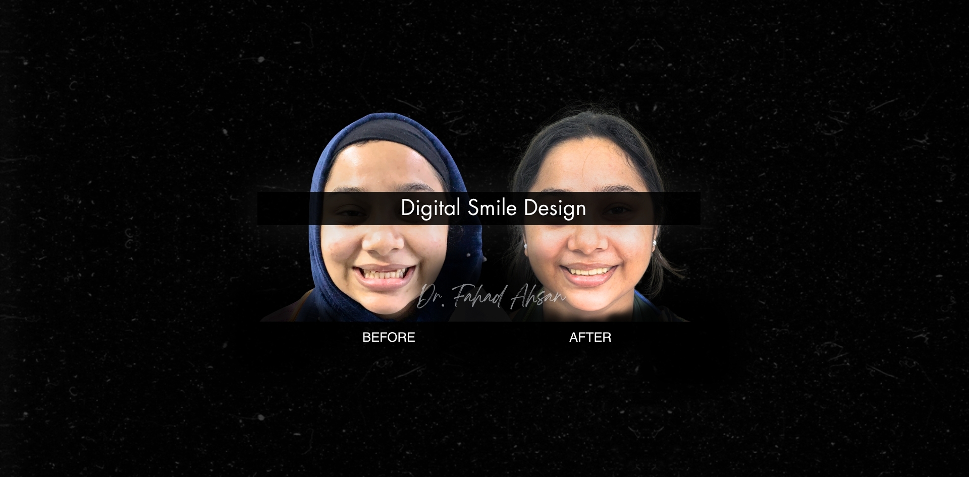 Hollywood Smile