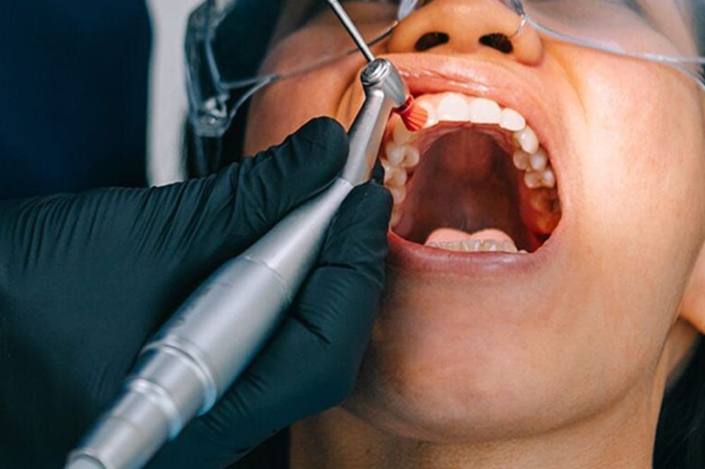 Regular Teeth Polishing